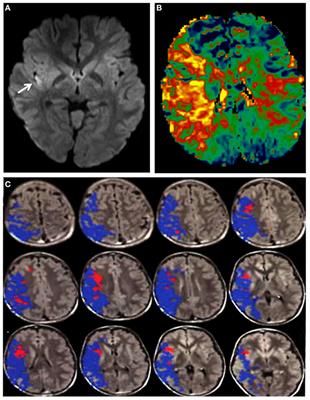 Acute Ischemic Pediatric Stroke Management: An Extended Window for Mechanical Thrombectomy?